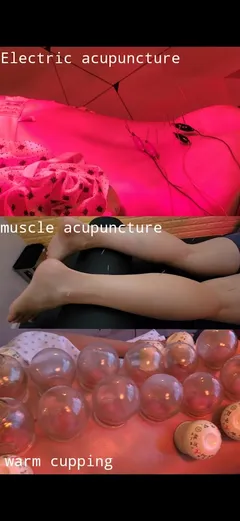 Cupping Technique