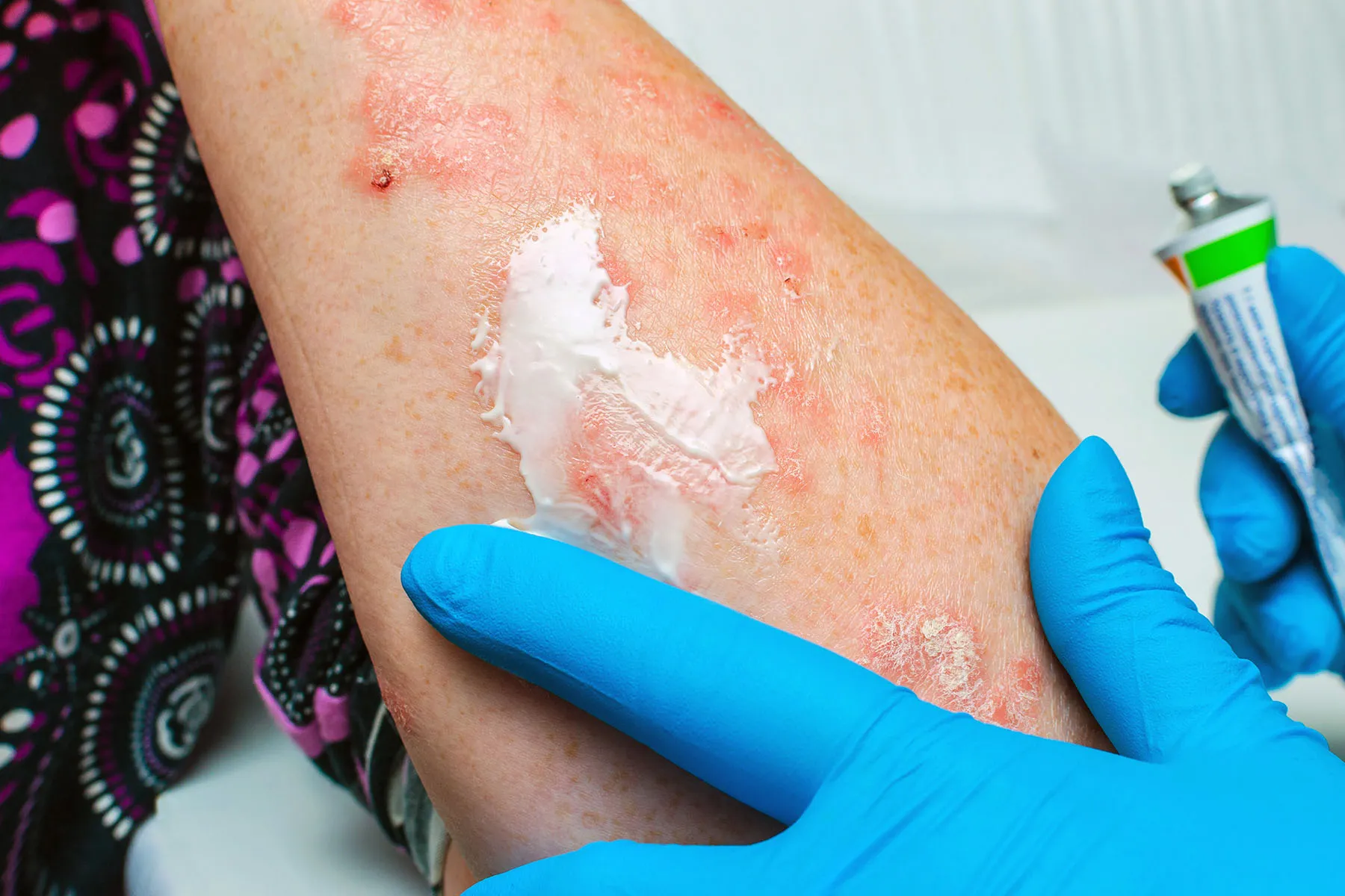 Other Nonsteroidal Topical Treatment Options