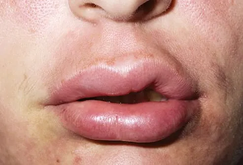 One Woman's 3-Year Lip Swelling Reveals Granulomatous Cheilitis
