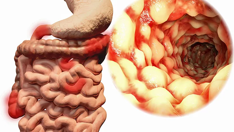 Study: Upadacitinib Linked to Lower Treatment Failure in UC Patients
