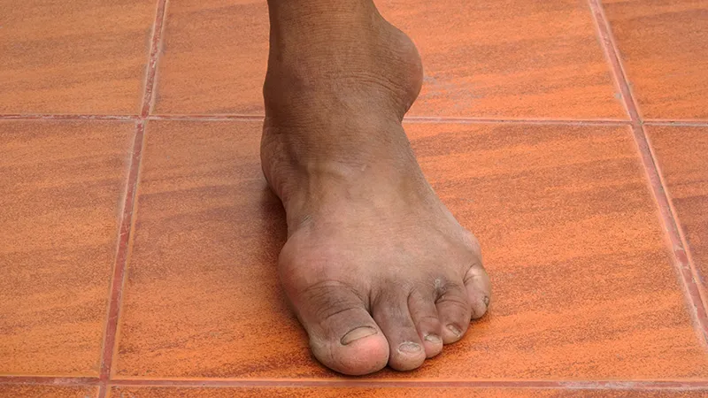 Truly Refractory Gout Is in Doubt