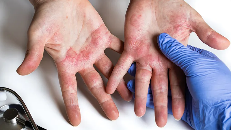 Stimulants Tied to Wider Erythromelalgia With Raynaud
