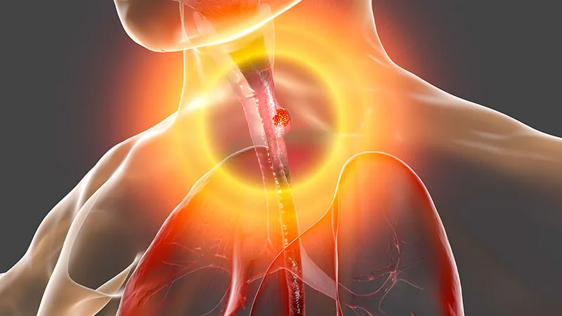 Sonesitatug Vedotin Improves OS in Gastroesophageal Cancer