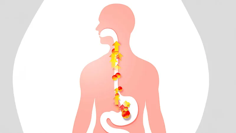 New Acid Blocker Eases Esophagitis Faster, No Healing Edge