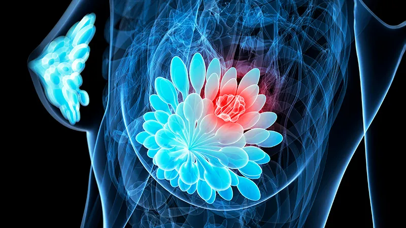 Healthy Lifestyle Tied to Better Health After Breast Cancer