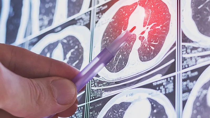 Low-Dose CT Features Tied to Lung Adenocarcinoma