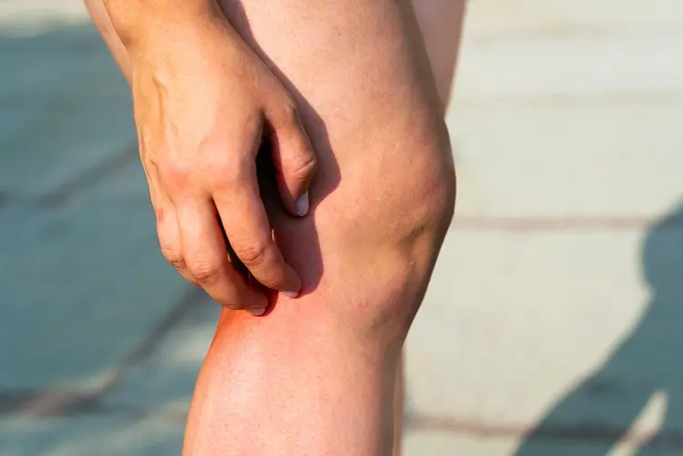 photo of woman scratching rash on leg