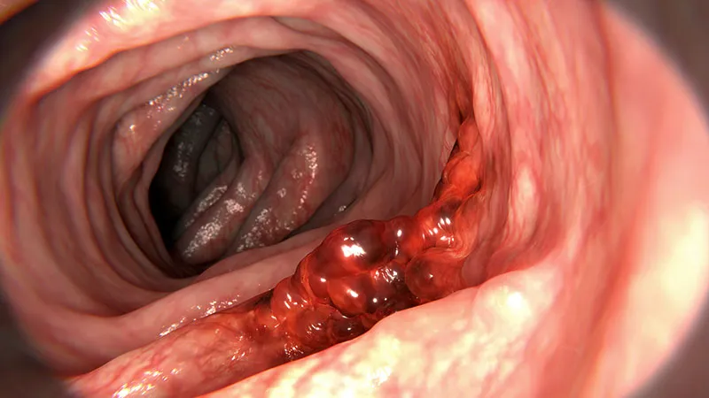 93% Higher Risk for Early-Onset Colorectal Cancer Linked to Biological Aging