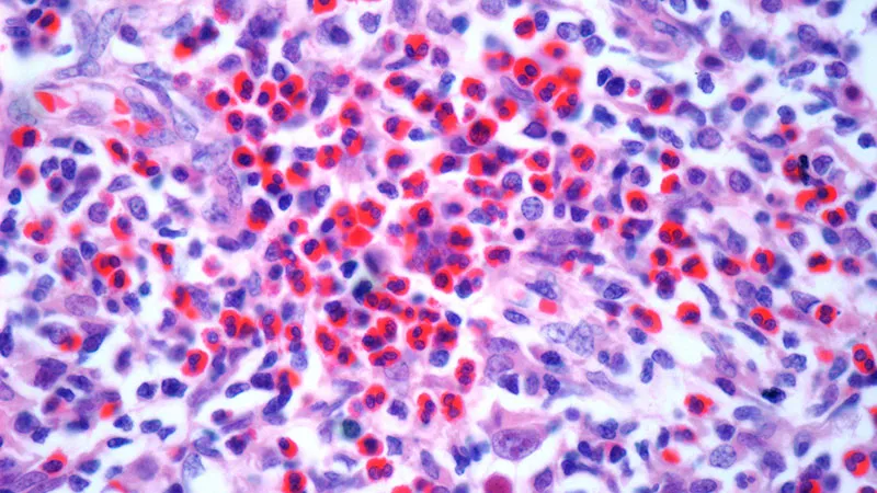 Eosinophil Guidance Curbs Steroid Use in Severe COPD
