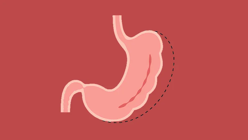 Reflux After Sleeve Gastrectomy? Bipartition May Help