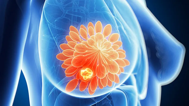 Shorter Breast Radiation Safe for Post-Reconstruction Outcomes