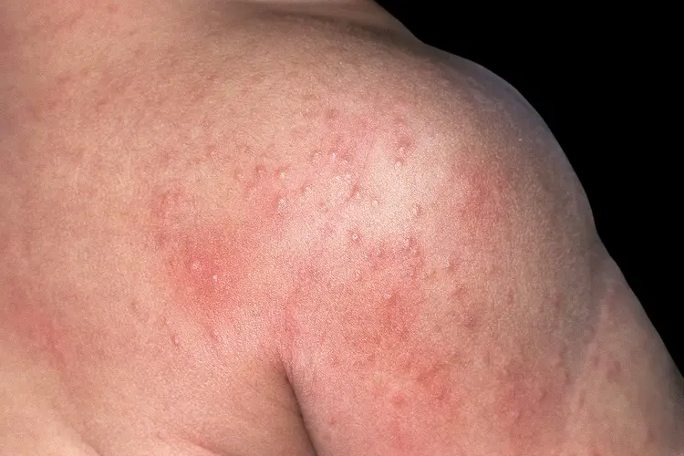 Prickly heat blisters