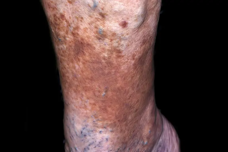 photo of hemosiderin staining in the lower leg, shows the reddish brown stains from iron which is a byproduct of the iron from the breakdown of red blood cells