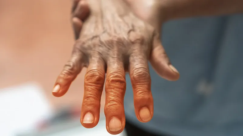 New Organ Damage Rare in Well-Controlled Lupus Pregnancies