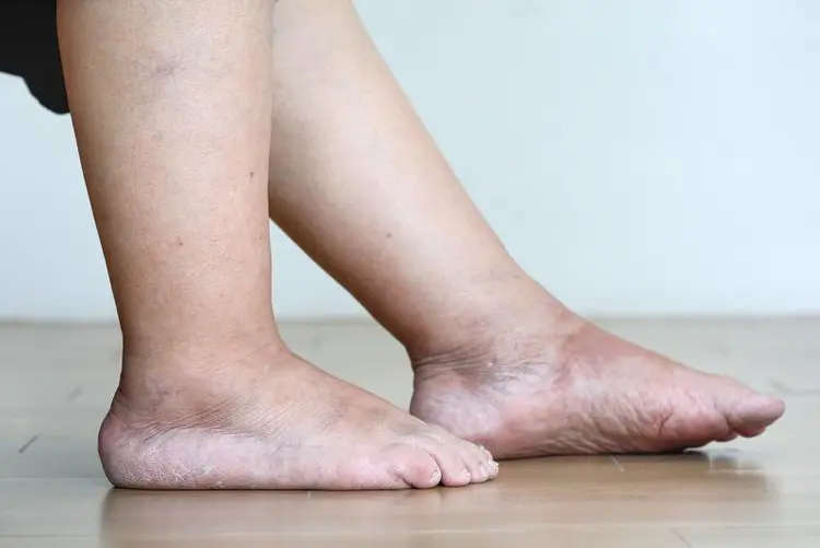 photo of swollen feet after pregnancy, also called postpartum edema or swelling