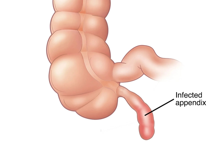 Appendicitis