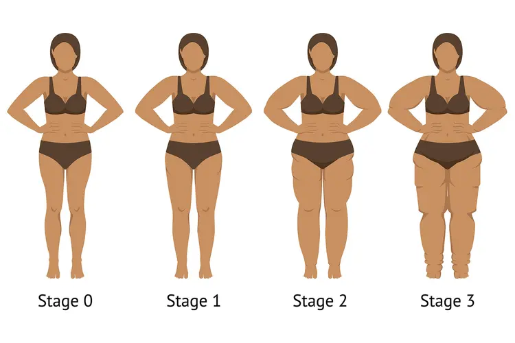 photo of lipedema