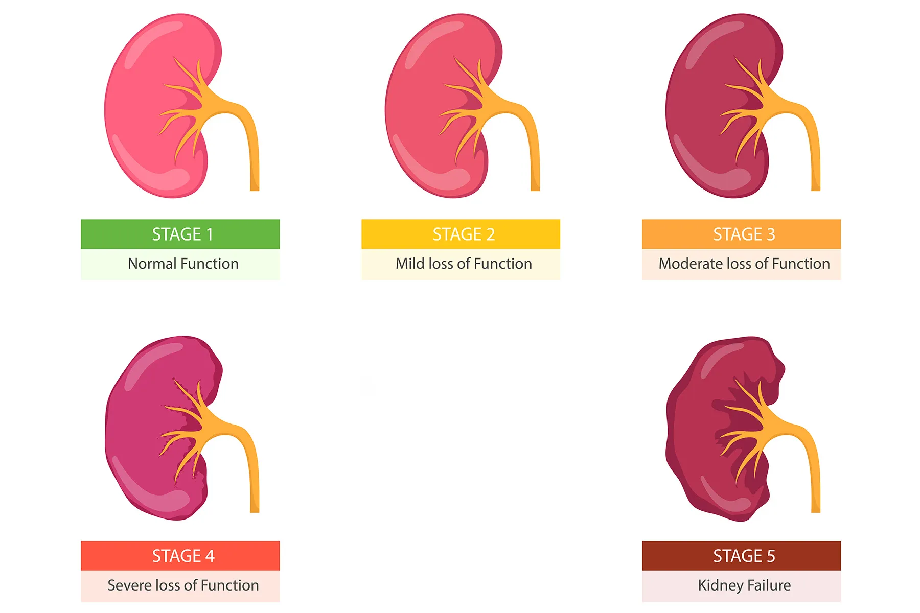 photo of kidney failure