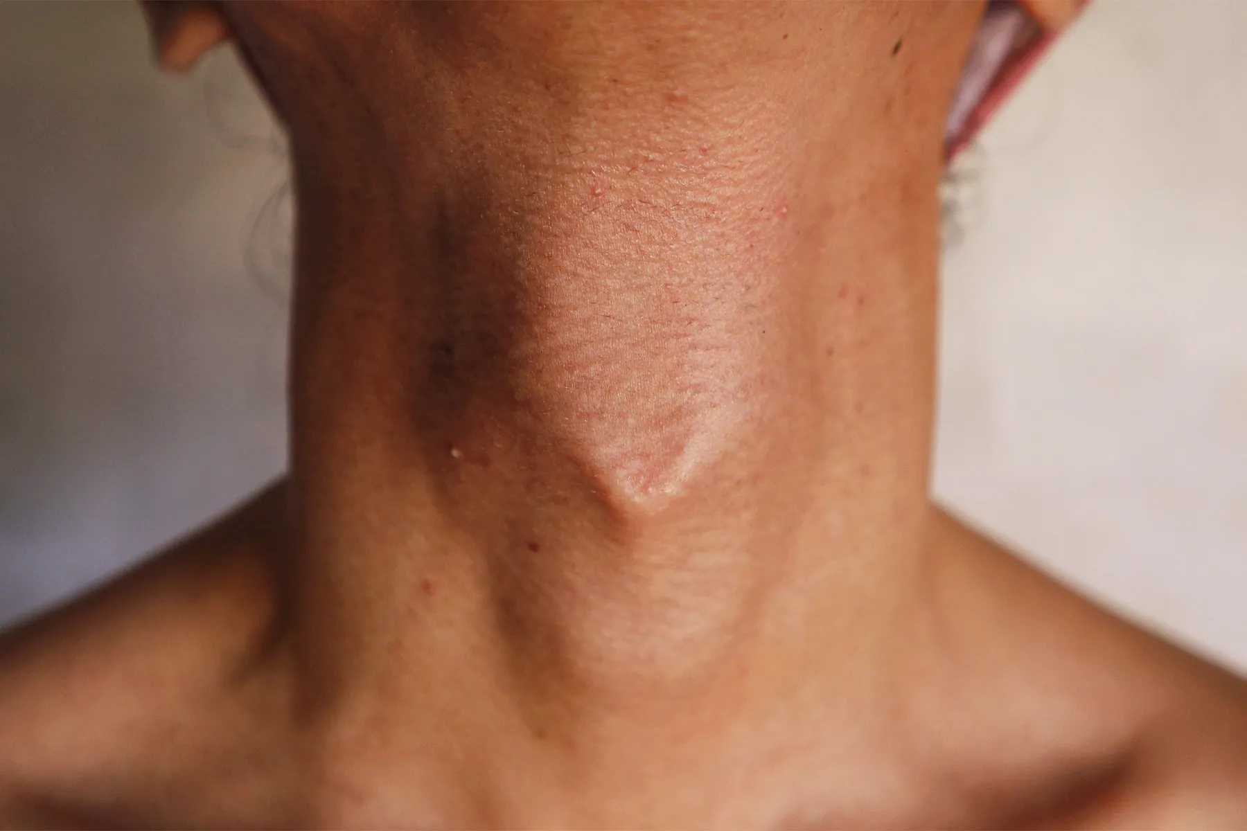 Swollen Adams Apple Close Up Of An Elderly Man Swallowing An Adam s