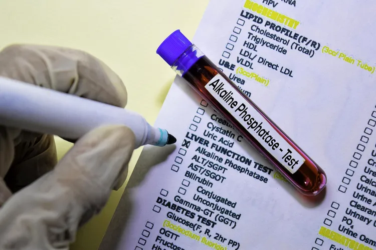 photo of Alkaline phosphatase blood test