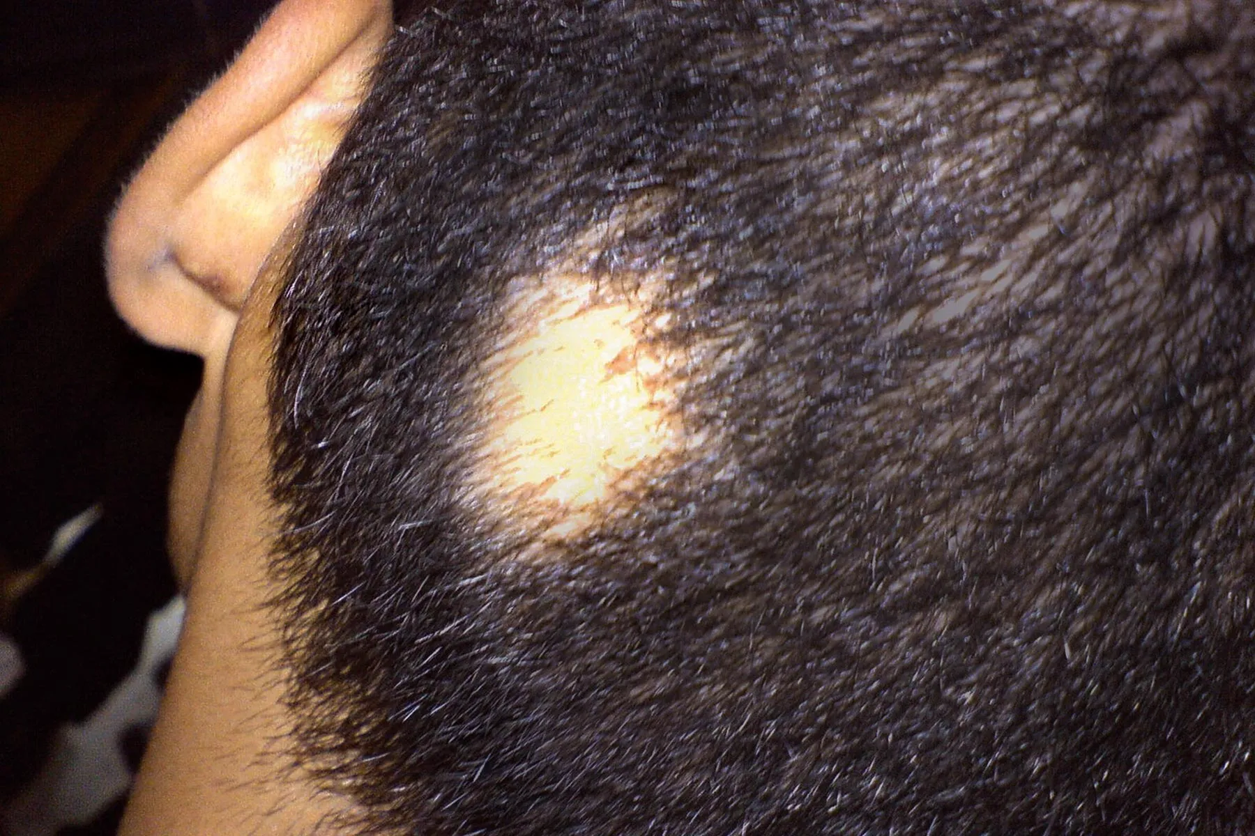 photo of alopecia areata