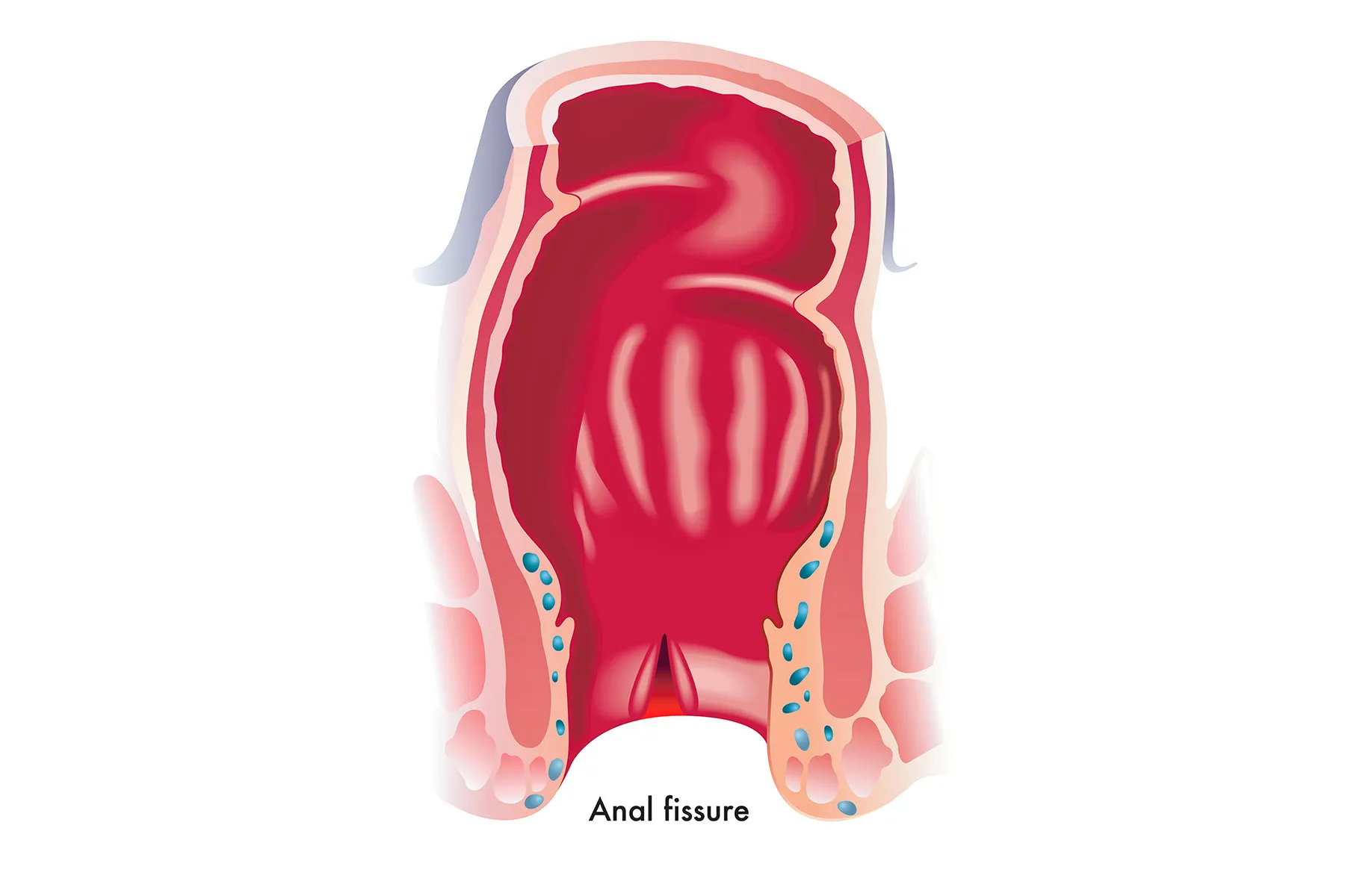 Anal Fissures Causes And Prevention