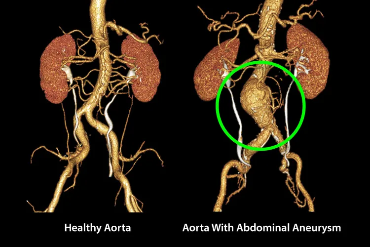 photo of healthy aorta vs aneurysm