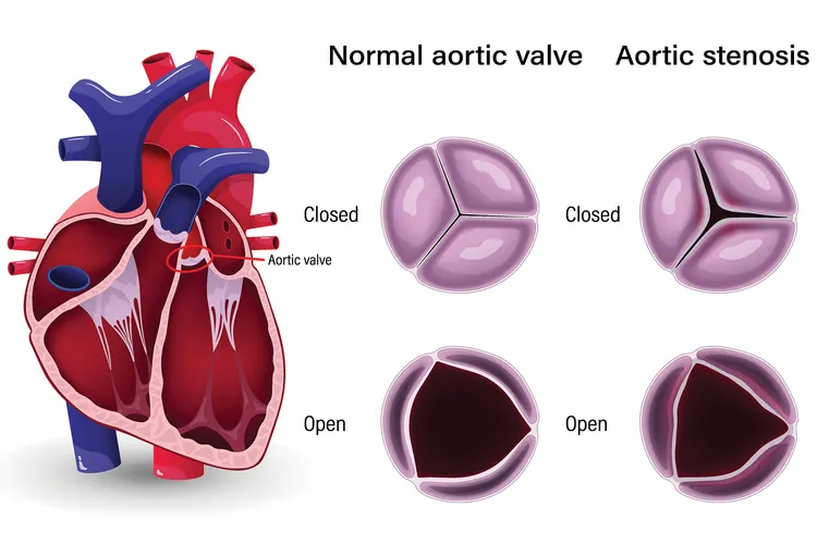 photo of aortic stenosis