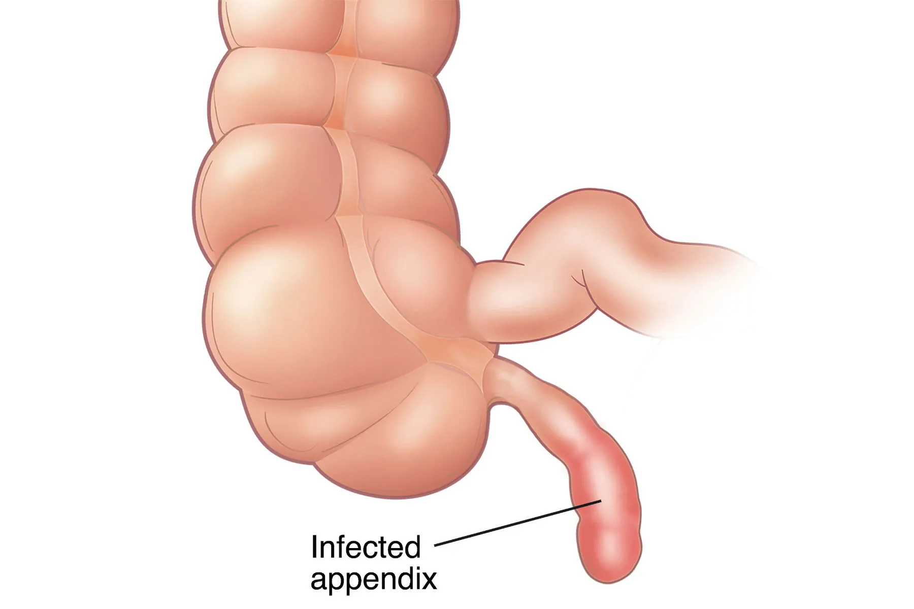 photo of appendicitis