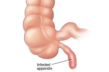 Appendicitis is an inflammation of the appendix, which is a 3 1/2-inch-long tube of tissue that runs from your large intestine on the lower right side of your body. You can get appendicitis from certain conditions, such as overgrowth of bacteria in your intestine, hardened poop, colitis, or infection from parasites. (Photo credit: Eric Olson/WebMD)