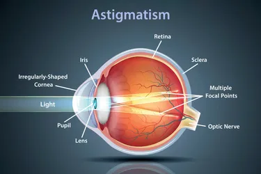 Astigmatism happens when your?cornea?is irregularly shaped, bending light in one direction more than another and leaving only part of an object in focus. (Photo Credit: iStock/Getty Images)