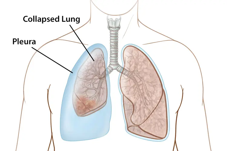 illustration of atelectasis