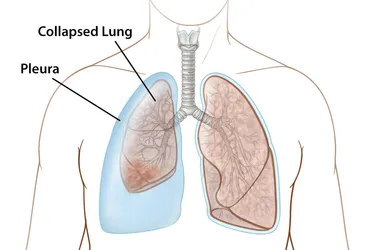 Atelectasis happens when the small sacs in your lungs (alveoli) can’t inflate properly, leading to a partial or full collapse of your lungs. (Photo Credit: Anna Kuo/WebMD Ignite)