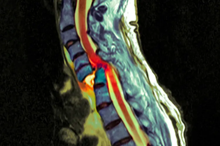 photo of fractured spine MRI