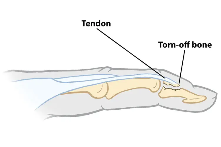 photo of avulsion fracture
