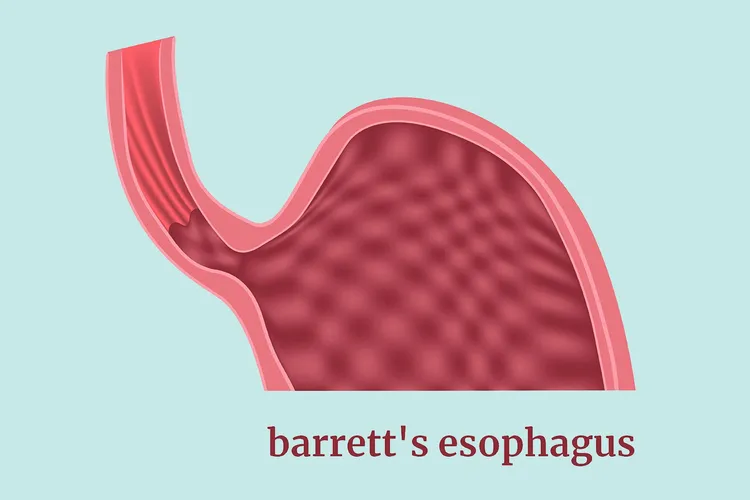 photo of Barrett's esophagus