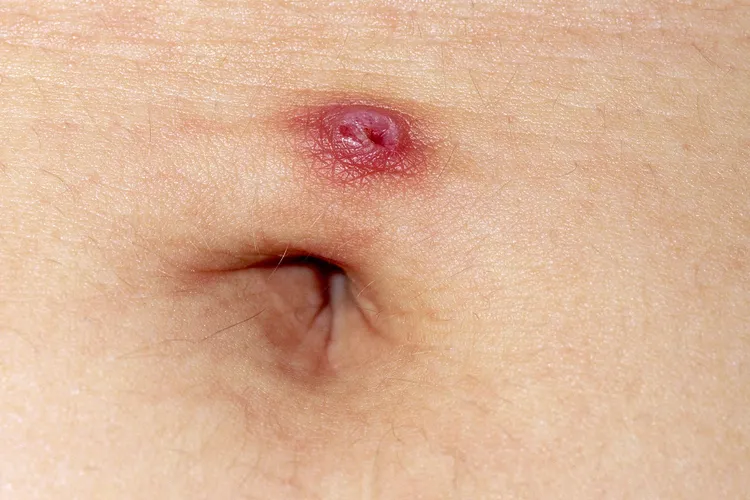 photo of infected belly button piercing
