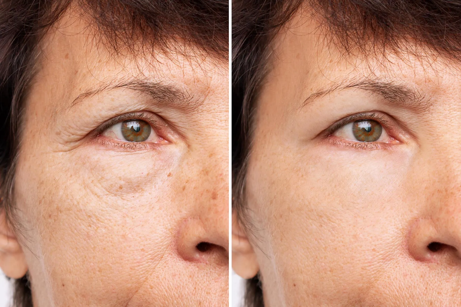 photo of blepharoplasty before and after