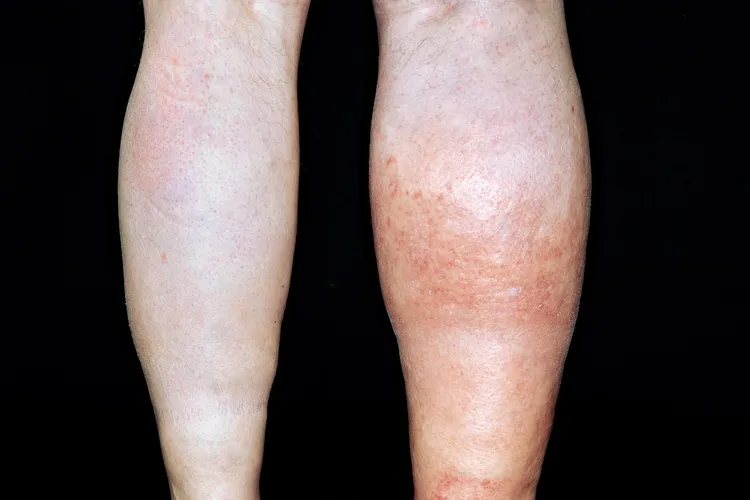 photo of deep vein thrombosis in man's leg