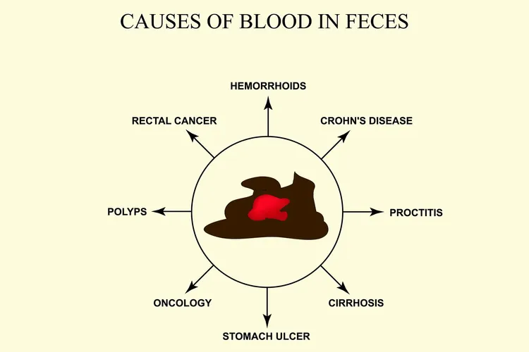 photo of Causes of blood in feces