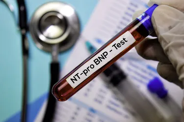 Your doctor can test for levels of related peptides called BNP or NT-proBNP in your blood to see if you have heart failure or if it may be getting worse. (Photo credit: Bang Oland/Dreamstime)