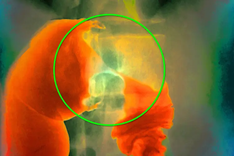 MRI of obstructive cancer of right colon