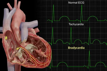EKG readings are the most important test your doctor will use to diagnose you with bradycardia. (Photo Credit: 3D4Medical/Medical Images)