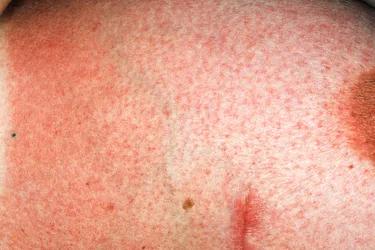 Rashes on or under your breast could be a sign of infection or a skin condition, or, less commonly, cancer. Photo credit: Medical Images 