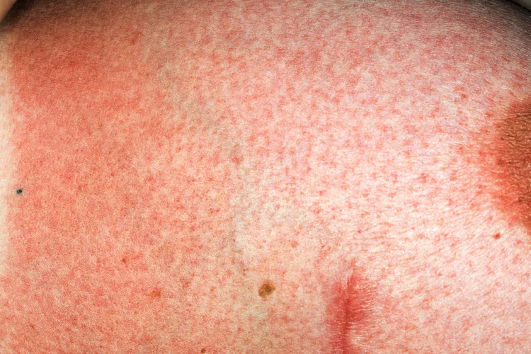 photo of radiation dermatitis