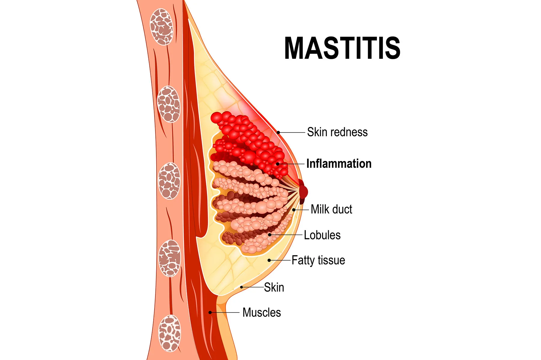 photo of Breast Mastitis