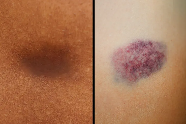 Bruises may start out red or purple on people with lighter skin tones. On people with darker skin tones, bruises can look purple, dark brown, or black. (Photo Credit: E+/Getty Images)