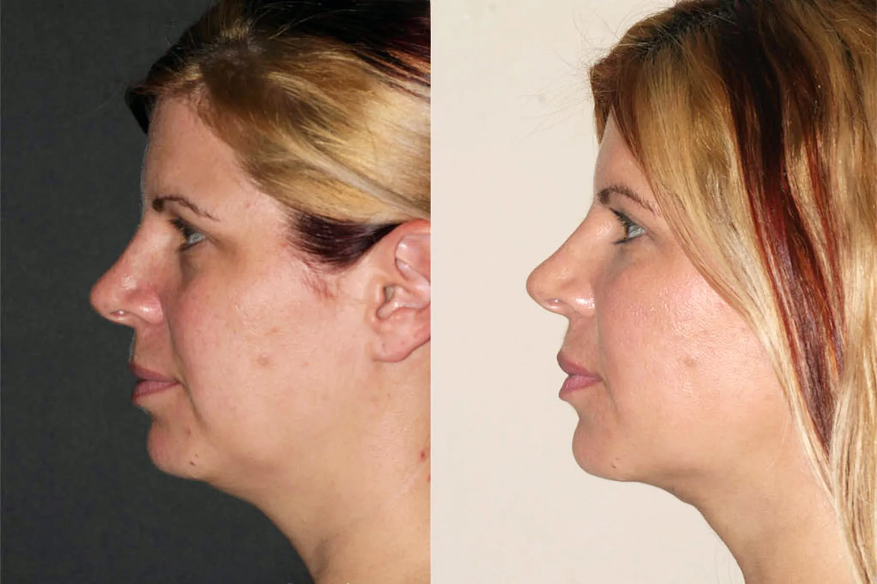 photos of buccal fat removal results