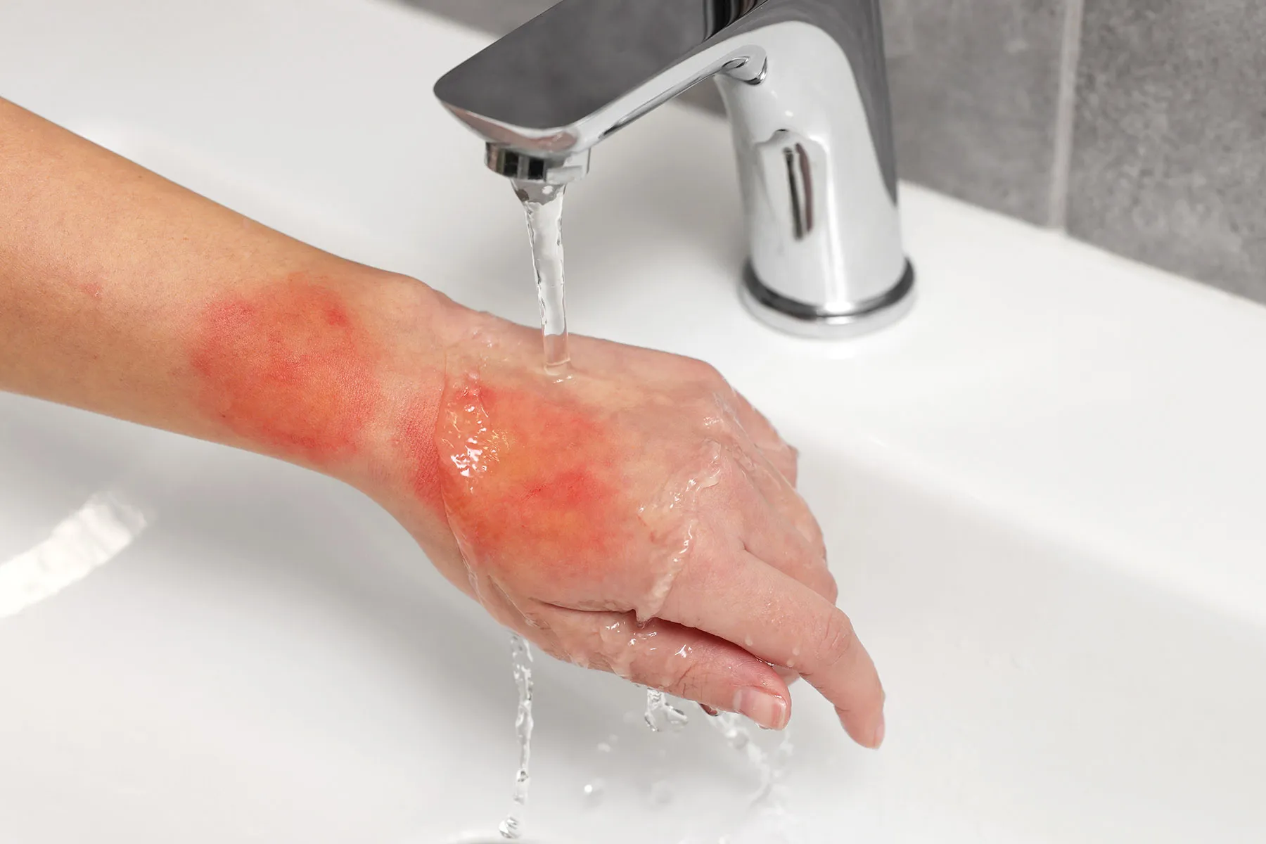 photo of Woman holding burned hand under cold water