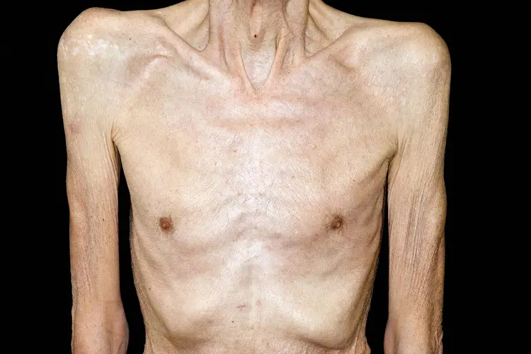 photo of man with cachexia